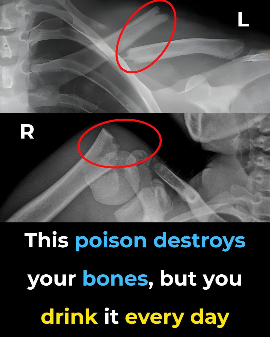 This Drink Will Destroy Your Bones From The Inside But Everyone Drinks It Anyway