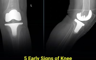 5 Hidden Early Signs of Knee Osteoarthritis Most People Don’t Notice