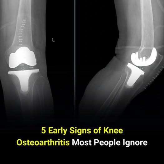 5 Hidden Early Signs of Knee Osteoarthritis Most People Don’t Notice