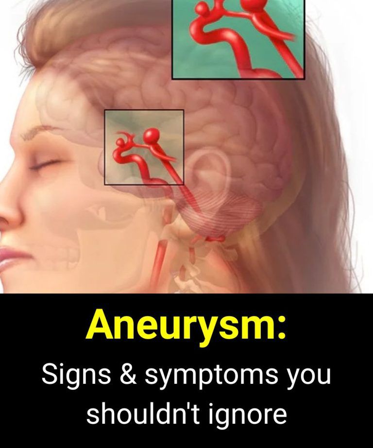 Silent Aneurysms: Why Some Brain Conditions Go Unnoticed