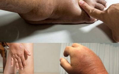 Swollen Hands and Feet: Common Causes and Hidden Dangers
