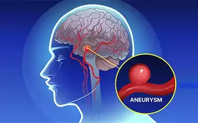 Brain Aneurysm: Causes, Symptoms, and Treatment Explained