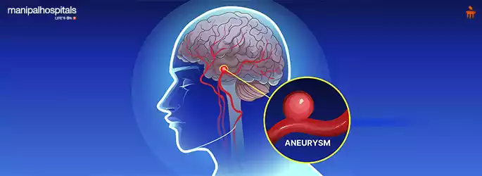 Brain Aneurysm: Causes, Symptoms, and Treatment Explained