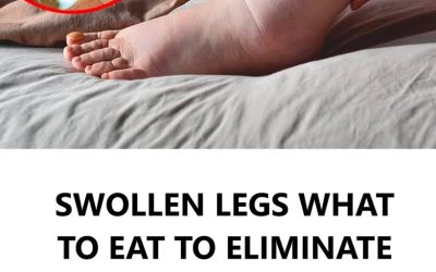 Water Retention: What Causes It and How to Eliminate It